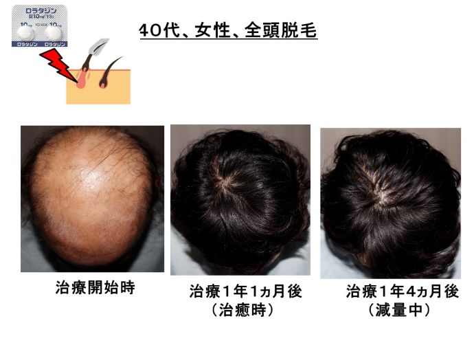 円形脱毛症　病院